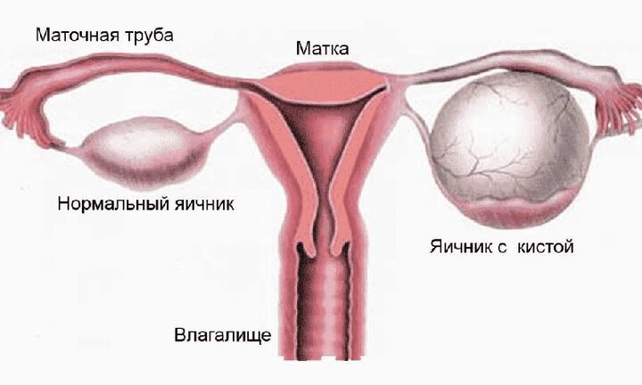 Лечение кисты яичника