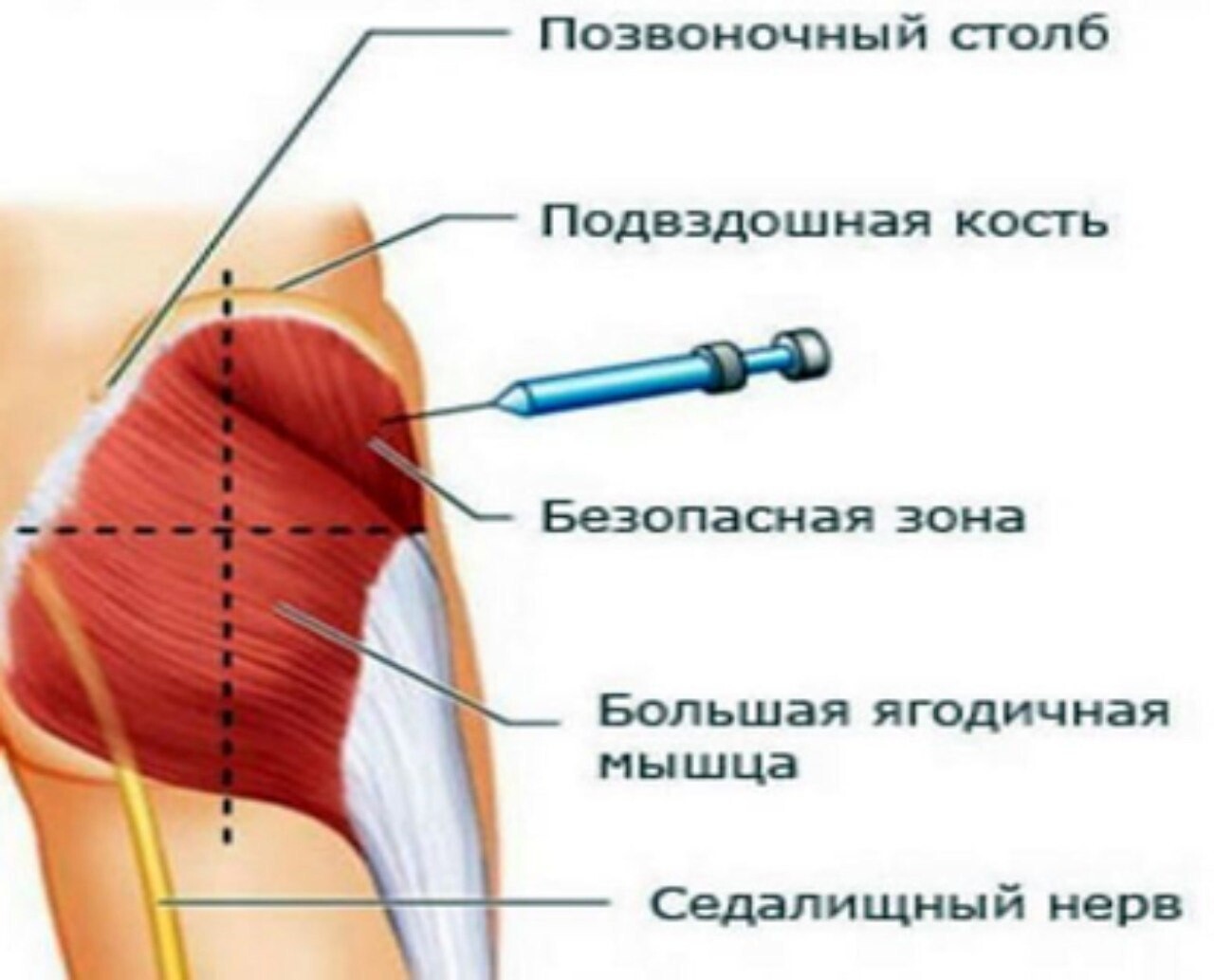 Болят мышцы после уколов что делать. Схема укола внутримышечно в ягодицу. Внутримышечная инъекция в ягодицу. Техника введения внутримышечно в дельтовидную мышцу. Схема введения укола в ягодицы.
