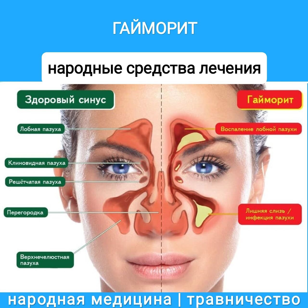 Современные методы лечения гайморита