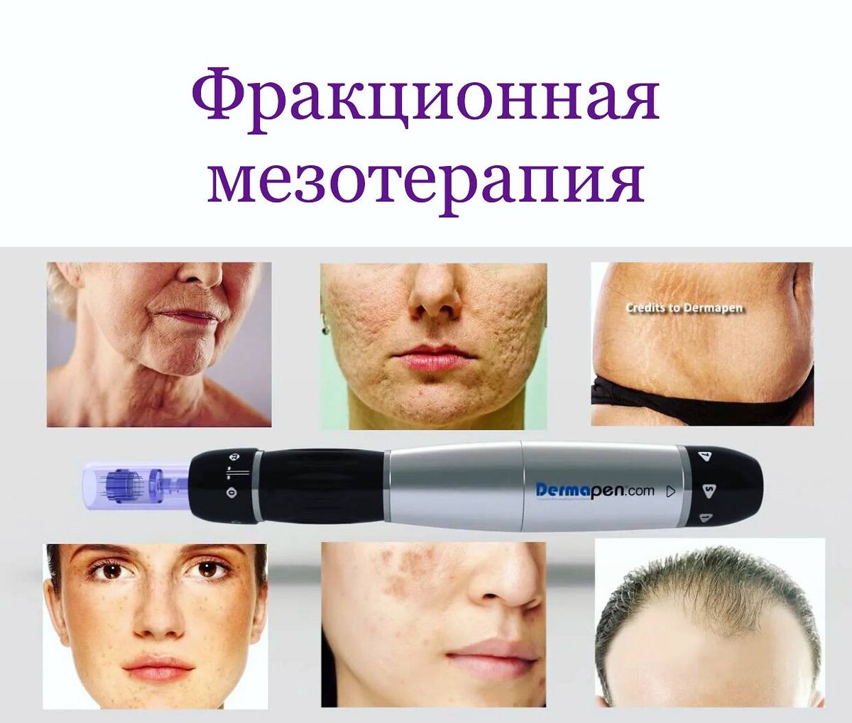 Фракционная мезотерапия эффект. Микронидлинг аппаратом Дермапен. Аппарат Дермапен для фракционной мезотерапии. Микроигольчатая терапия Дермапен. Фракционная мезотерапия (микронидлинг).