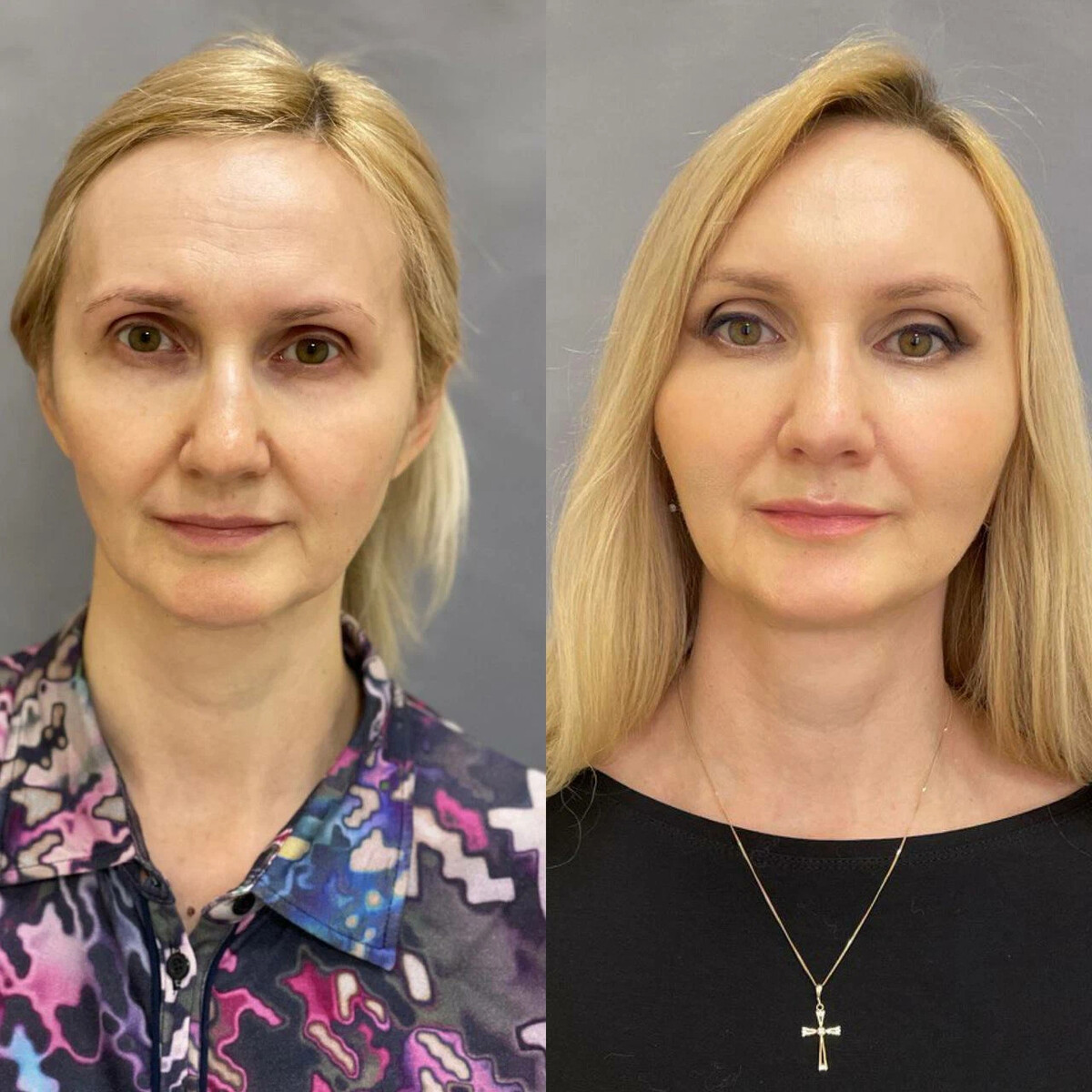 подтяжка лица фото до и после