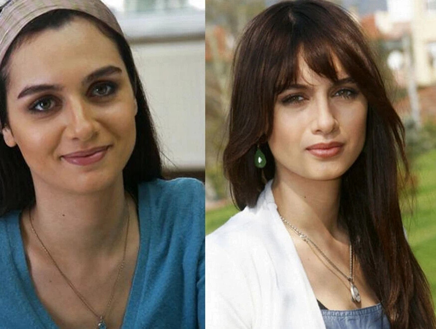 Бирдже акалай пластика до и после Бирдже Акалай Эта актриса, занявшая в 2004 году третье место на конкурсе. Семейн