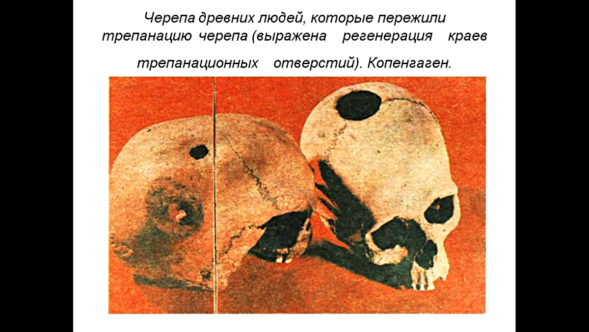 Трепанация это. Трепанация черепа в древности. Древние люди Трепанация черепа. Трепанация черепа в древнем Египте. Древний трепанированный череп