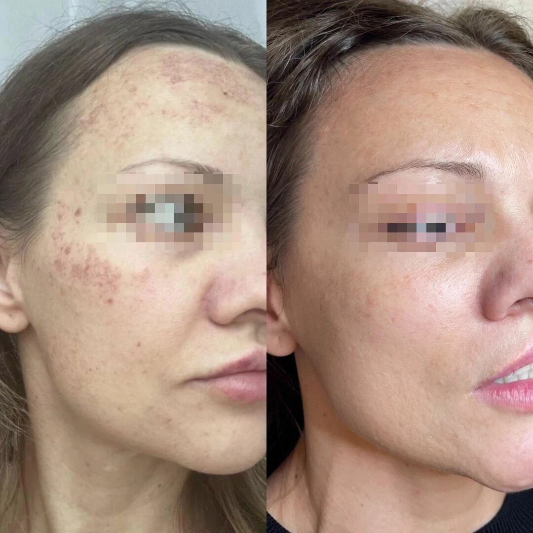 Как выглядит лицо после фототерапии