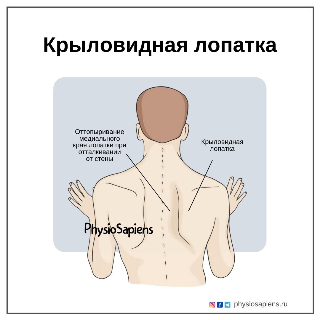 Как выглядит лопатка человека Крыловидные лопатки. Или что делать, когда они торчат? 