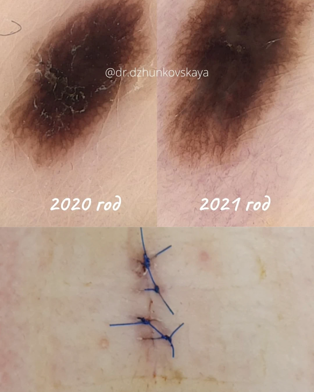 Самая рання стадия рака кожи - меланома in situ. Эту родинку я ...