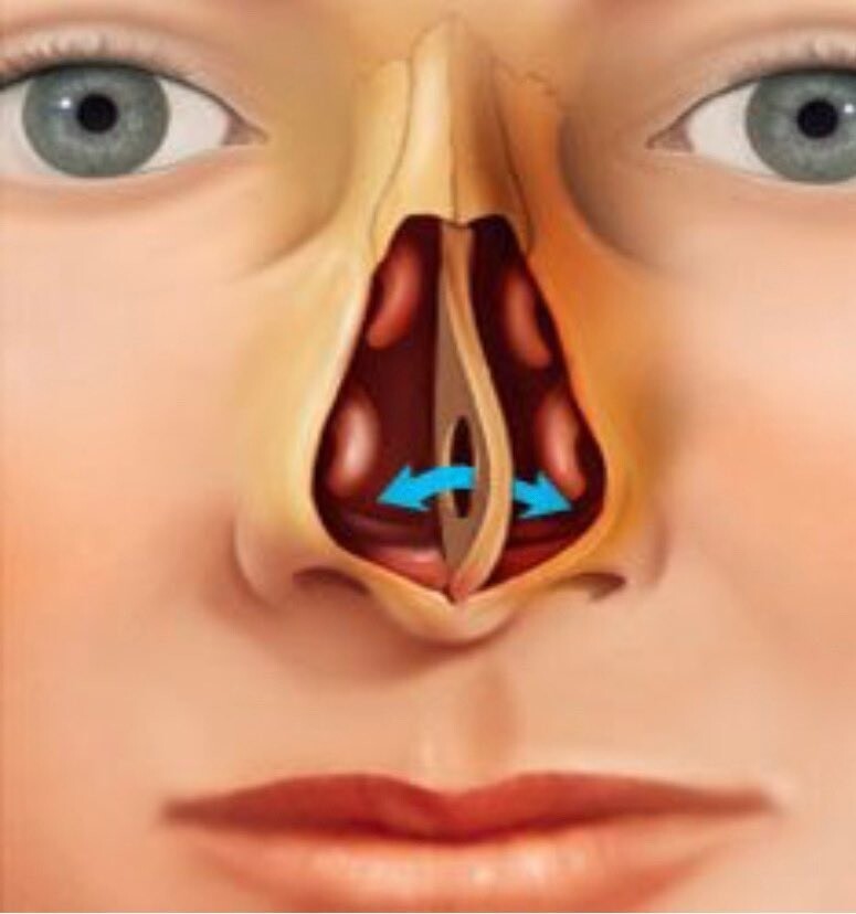 Искривление носовой перегородки