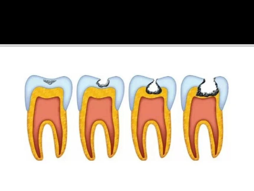 Почему зубы отличаются. Пломбирование кариеса композит. «Слоёная» техника пломбирования зуба с кариесом.. Генерализованный кариес.