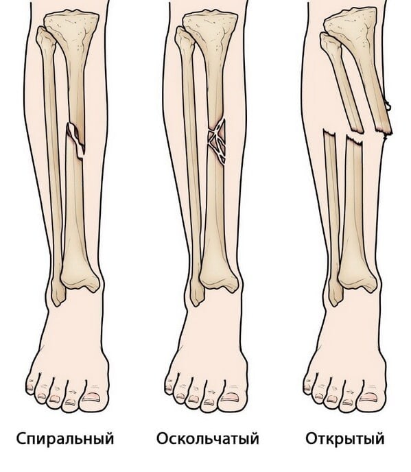 Нижних конечностей 4. Перелом большеберцовой кости. Перелом диафиза большеберцовой кости спиральный. Перелом голени большеберцовой кости. Большеберцовая кость поперечный перелом.