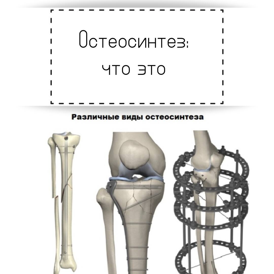 Операция вставление пластины. Перелом большеберцовой кости остеосинтез. Внутрикостный остеосинтез большеберцовой кости. Остеосинтез перелома бедра. Остеосинтез перелома берцовой кости.