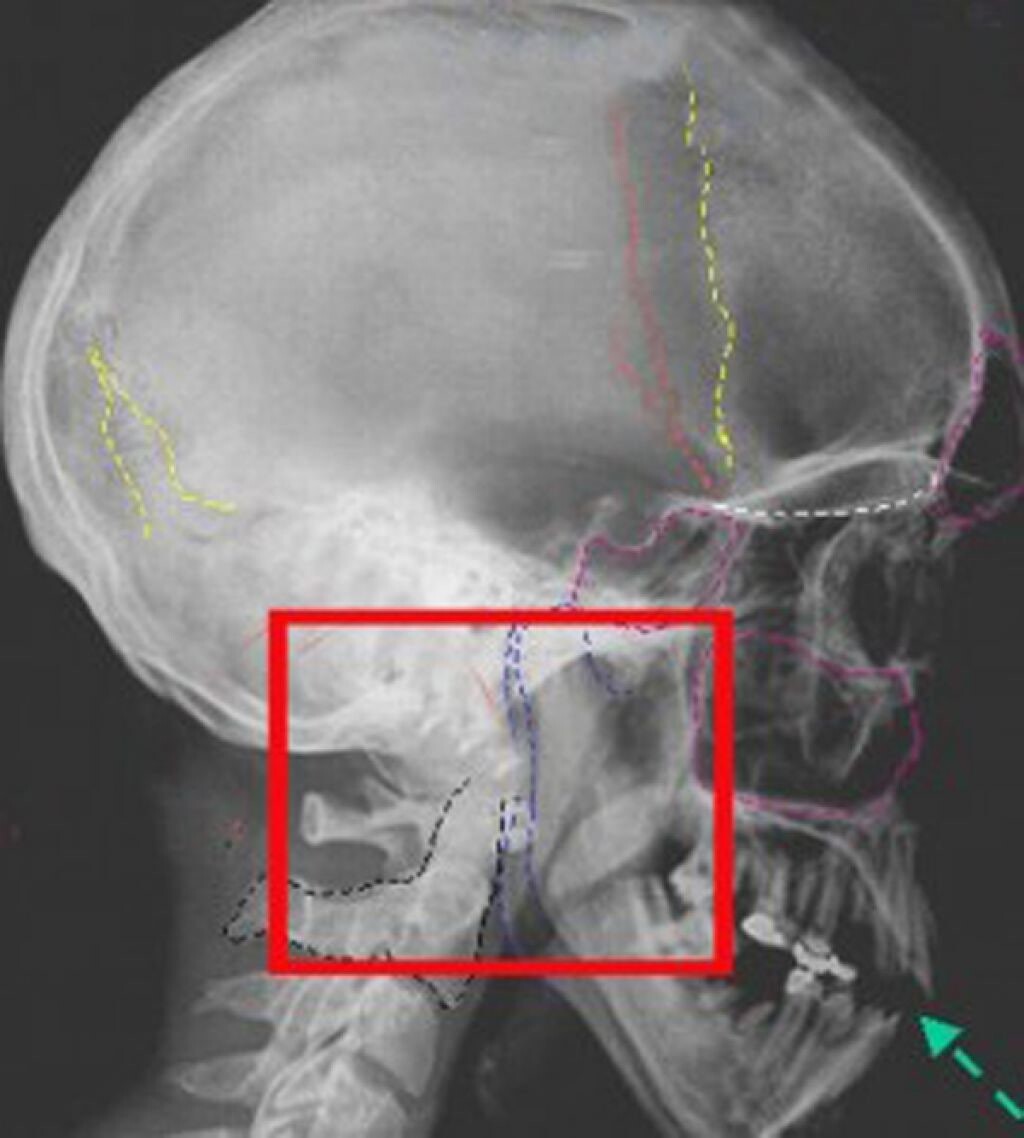 Трещина задней стенки. Базилярный перелом черепа. Оскольчатый перелом основания черепа. Перелом костей свода и основания черепа. Оскольчатый вдавленный перелом свода черепа.