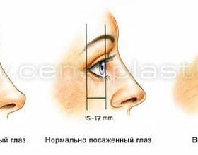Как выглядят глубоко посаженные глаза