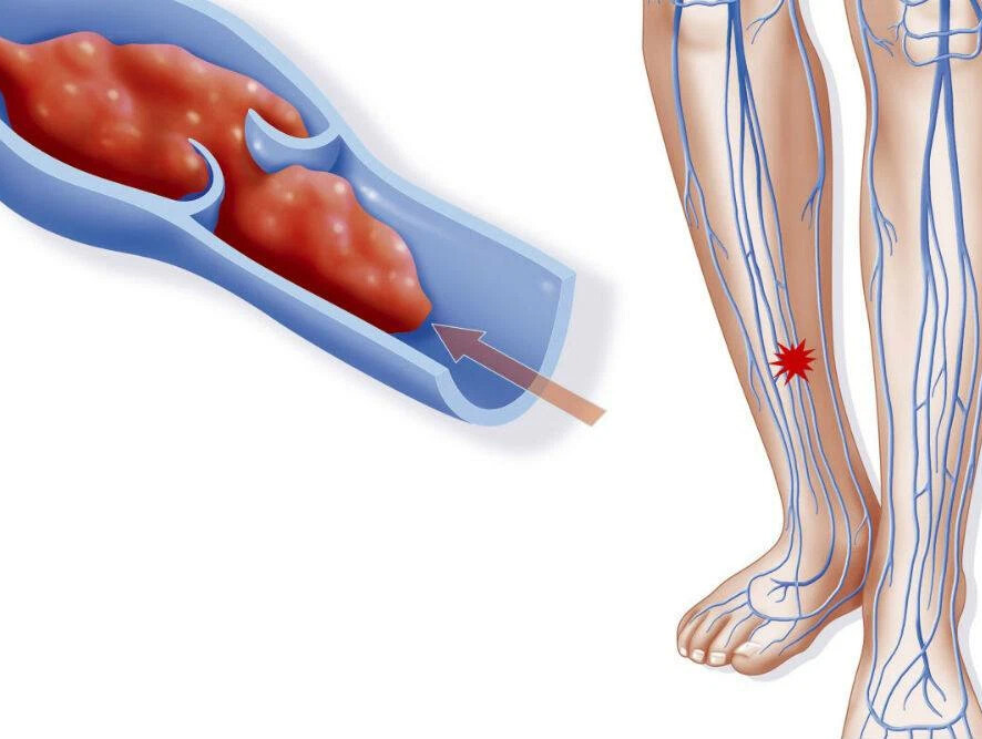Тромбоз вен картинки