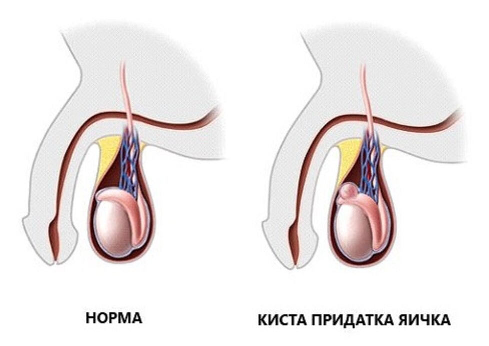 Гидроцеле клиническая картина диагностика лечение