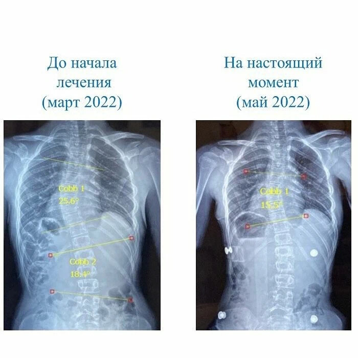 Лечение сколиоза воронеж. Шрот терапия при сколиозе. Гимнастика Шено при сколиозе. Центр сколиоза шрот. Гимнастика шрот при сколиозе 3 степени.