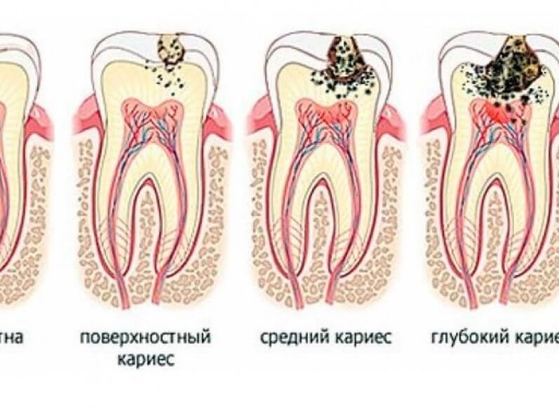 План лечения поверхностного кариеса