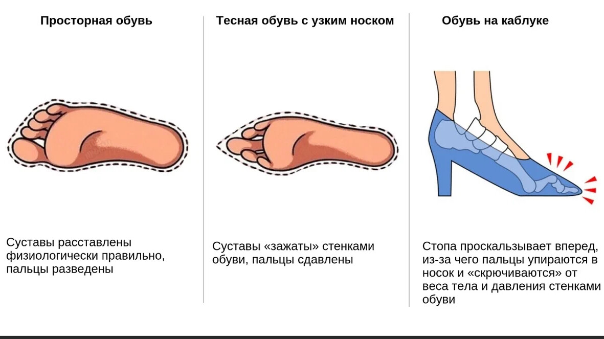 Неправильно подобранная обувь