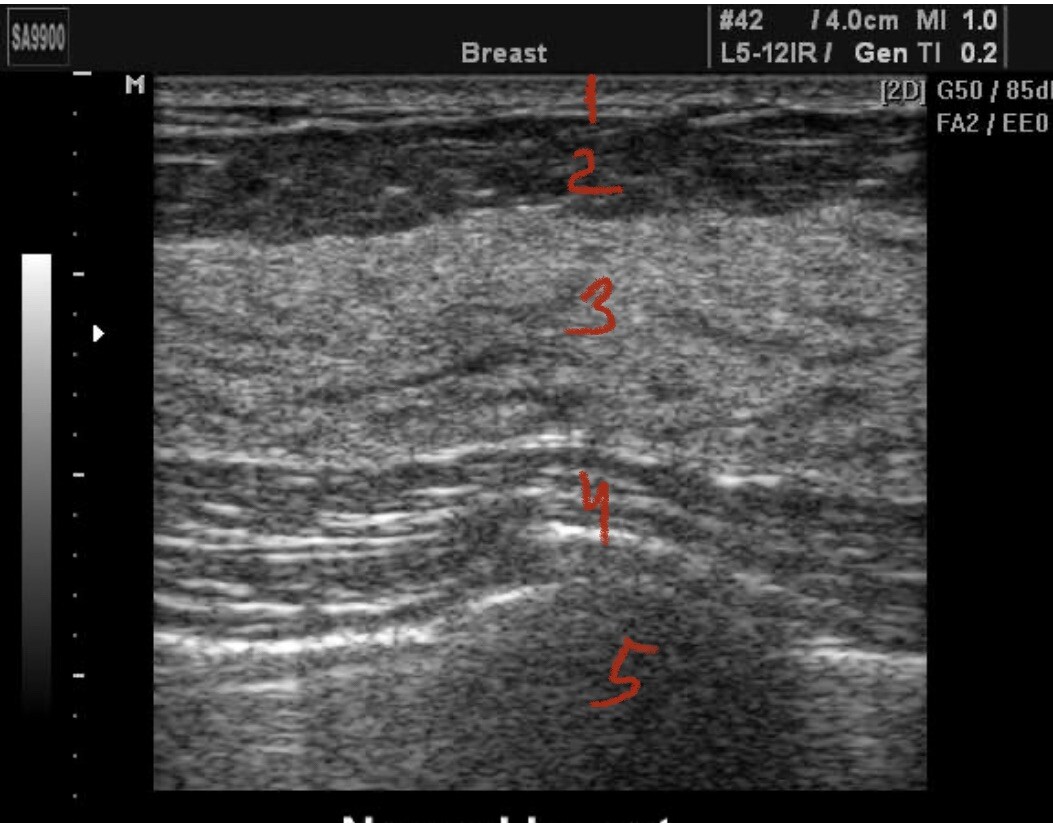 Молочная железа на узи молочной железы. Ультразвуковое исследование (УЗИ) молочных желез. Нормы протоков молочной железы на УЗИ. Ультразвуковая анатомия молочной железы. Олеогранулема молочной железы на УЗИ.