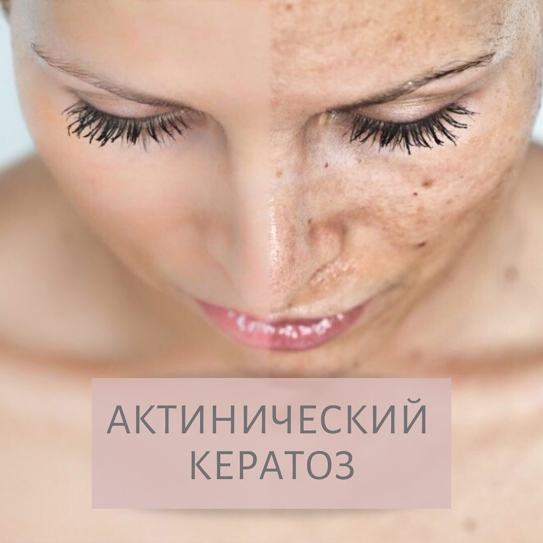 Гиперпигментация кожи лица косметология