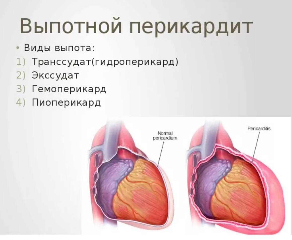 Сердечная скопление жидкости. Перикардит гидроперикардит. Экссудативный перикардит. Экссудативный перикардит выпотной.