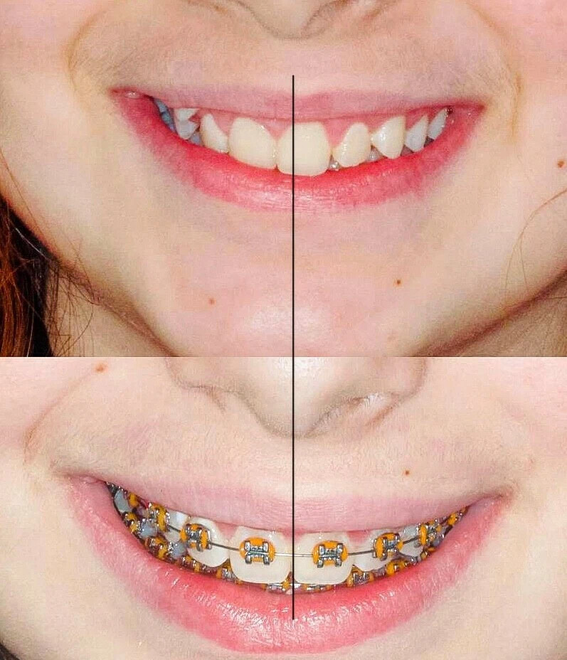 Mini diamond ormco. Брекитами или брекетами. Сколько стоят брекеты под ключ. Брекеты металлические безлигатурные damon q. Сколько стоят брекеты под ключ.