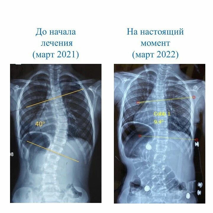 Лечение сколиоза 3 степени у взрослых. Юношеский идиопатический сколиоз. Идиопатический сколиоз 3 степени. Классификация сколиоза по шрот. Книга про идиопатический сколиоз.