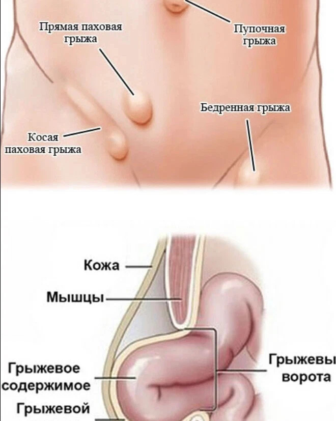 Грыжа справа. Вентральная грыжа пупочная околопупочная. Ущемленная эпигастральная грыжа. Грыжевые ворота паховой грыжи у мужчин. Схема паховой грыжи у мужчин.