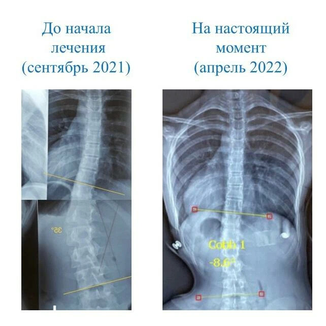Лечение сколиоза воронеж. Юношеский идиопатический сколиоз. Юношеский идиопатический сколиоз 3 степени. Классификация сколиоза по шрот. Шрот сколиоз.