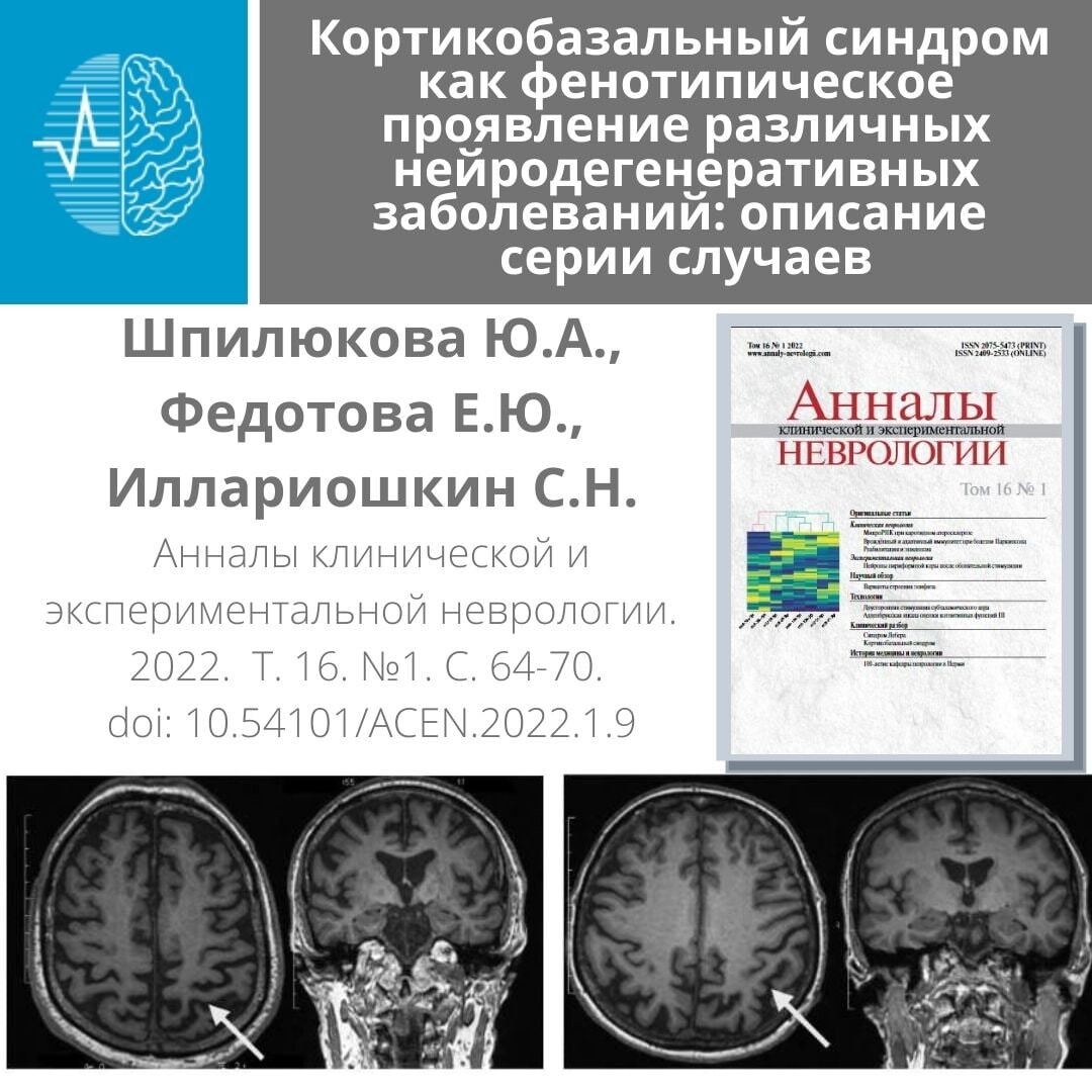 Кортикобазальный синдром. Кортикобазальная дегенерация. Кортикобазальная дегенерация клинические рекомендации. Кортикобазальная дегенерация мрт.