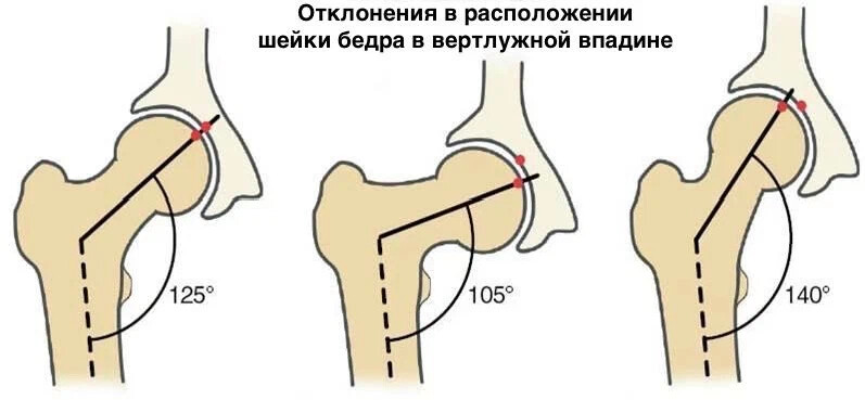 Рентгенологическая картина центрации головки бедра в пределах вертлужной впадины с обеих сторон