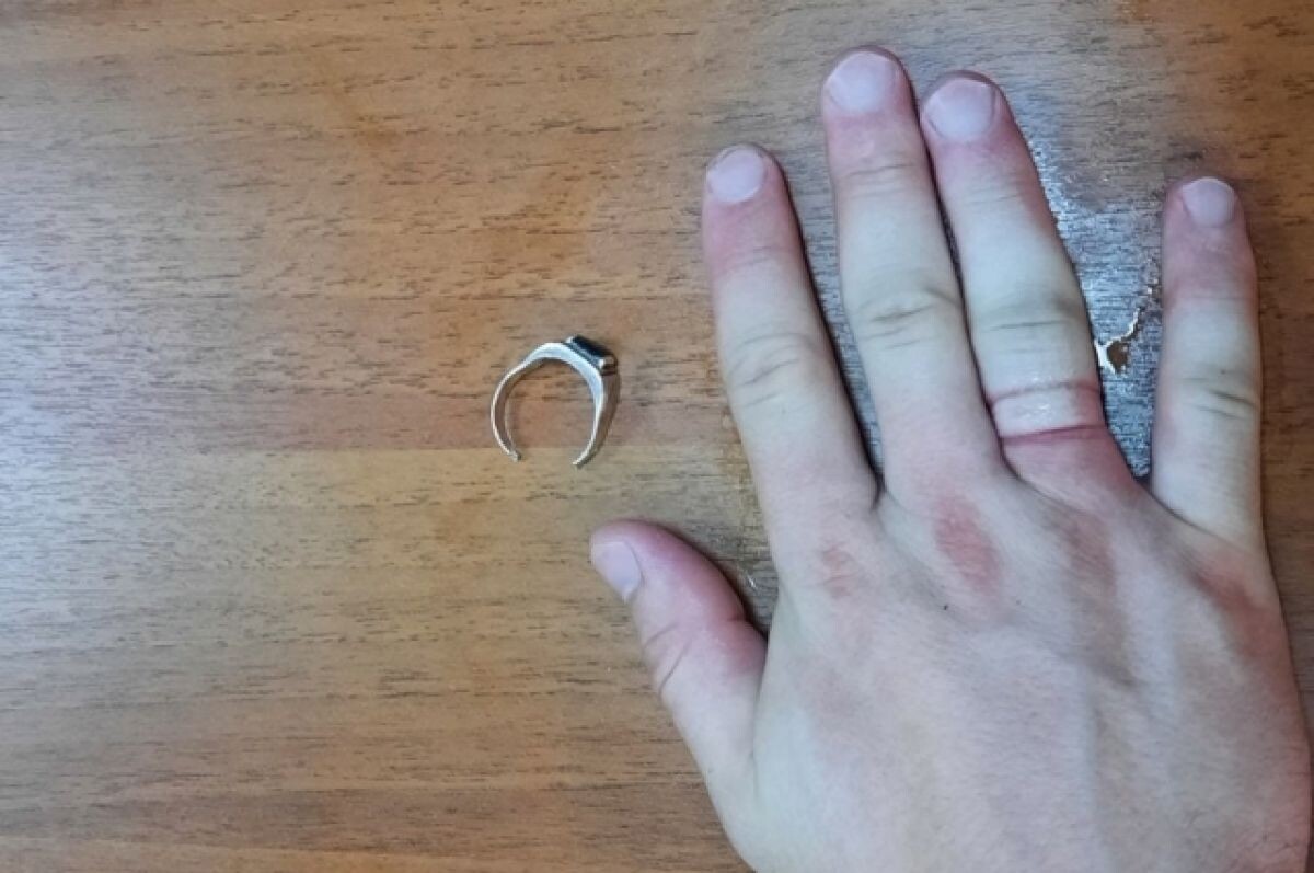 Застряло кольцо на пальце