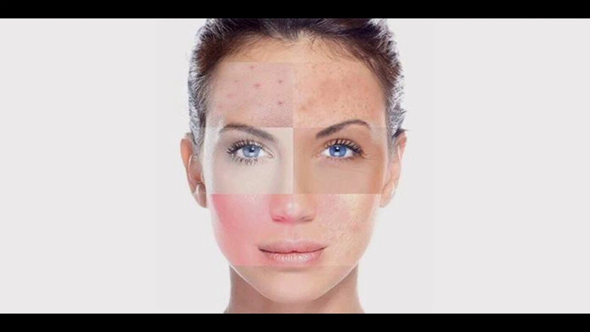 Как выглядит комбинированная кожа лица фото