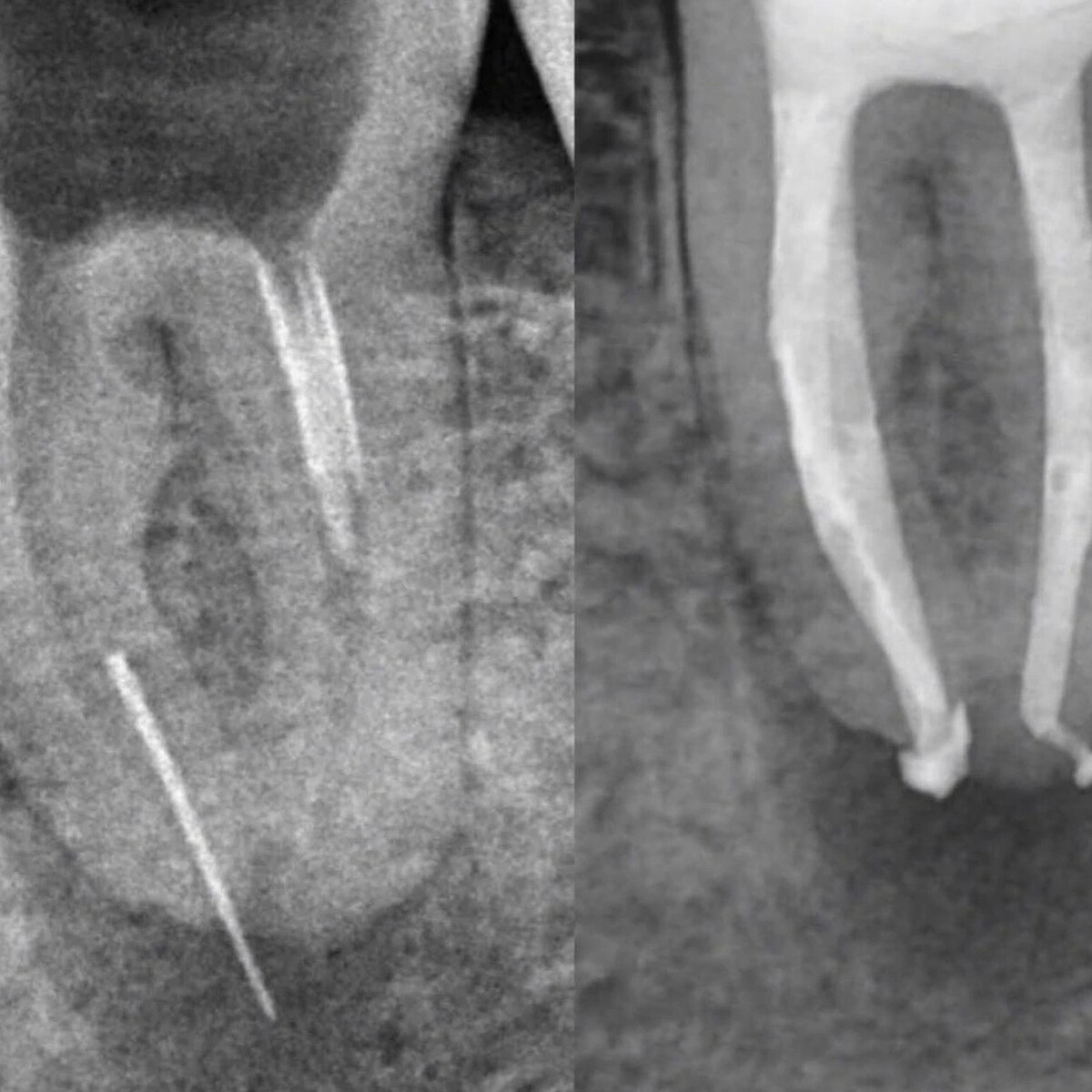 После эндодонтического лечения. Травматический периодонтит рентген. Рентген зуба эндодонтия.