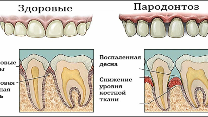 Как выглядит зуб под десной