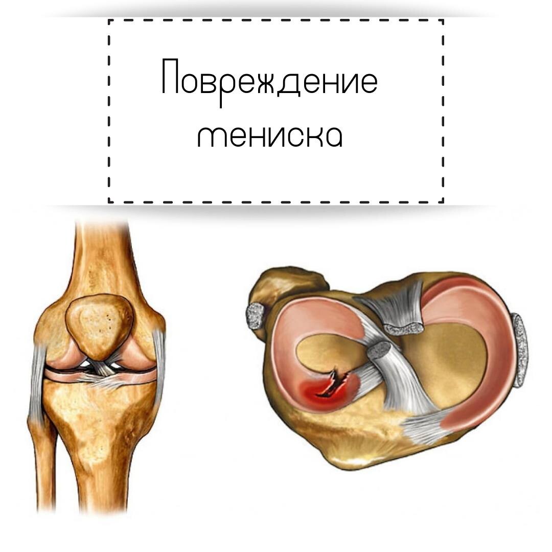 Застарелое повреждение менисков мкб. Разрыв внутреннего мениска. Мениск коленного сустава. Менископатия коленного.