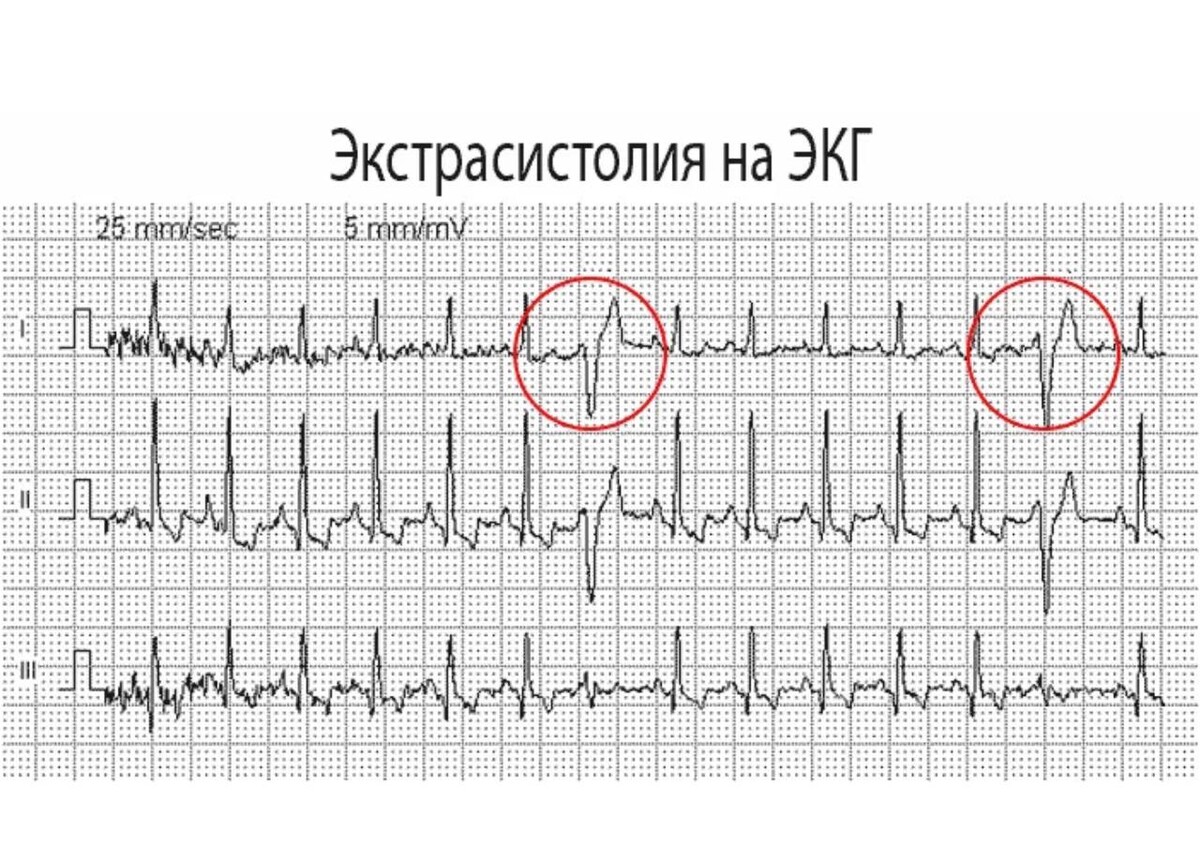 Как выглядит экстрасистолия на экг фото