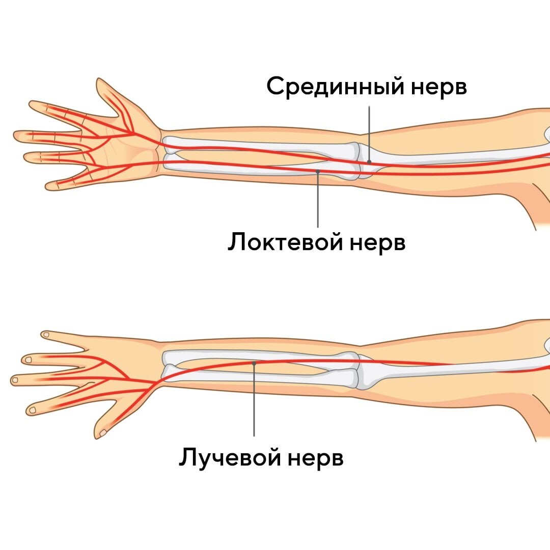 Нейропатия срединного нерва на руке. Невролиз локтевого нерва. Проекция лучевого нерва. Невролиз срединного нерва.