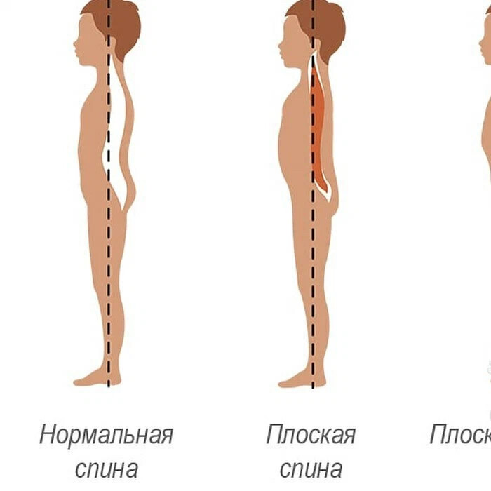 Картинки плоская спина