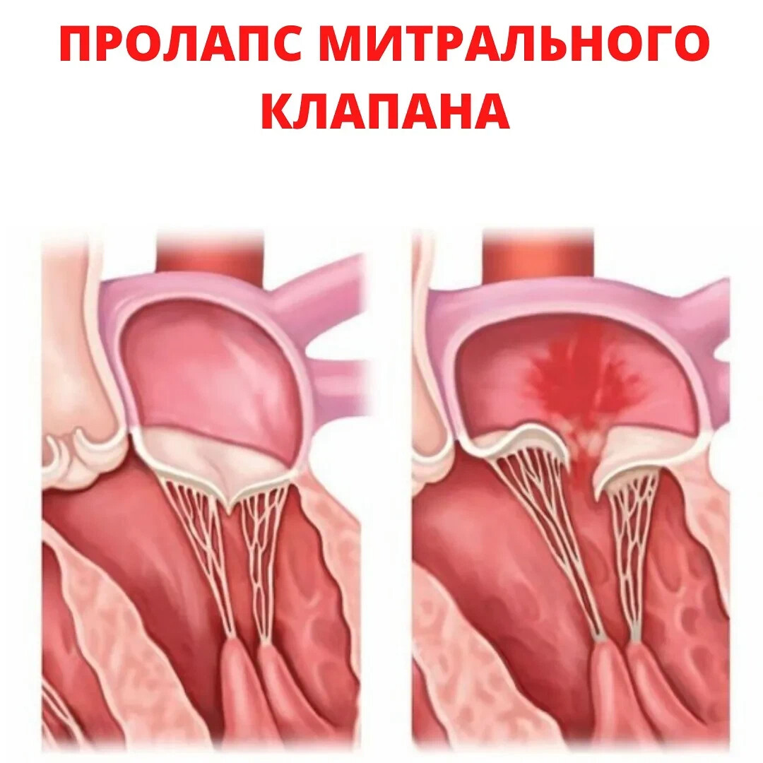 Регургитация митрального клапана. Пролапс митрального клапана 3 степени. Митральная и трикуспидальная регургитация. Митральный клапан макропрепарат. Марс пролапс митрального клапана 1 степени.