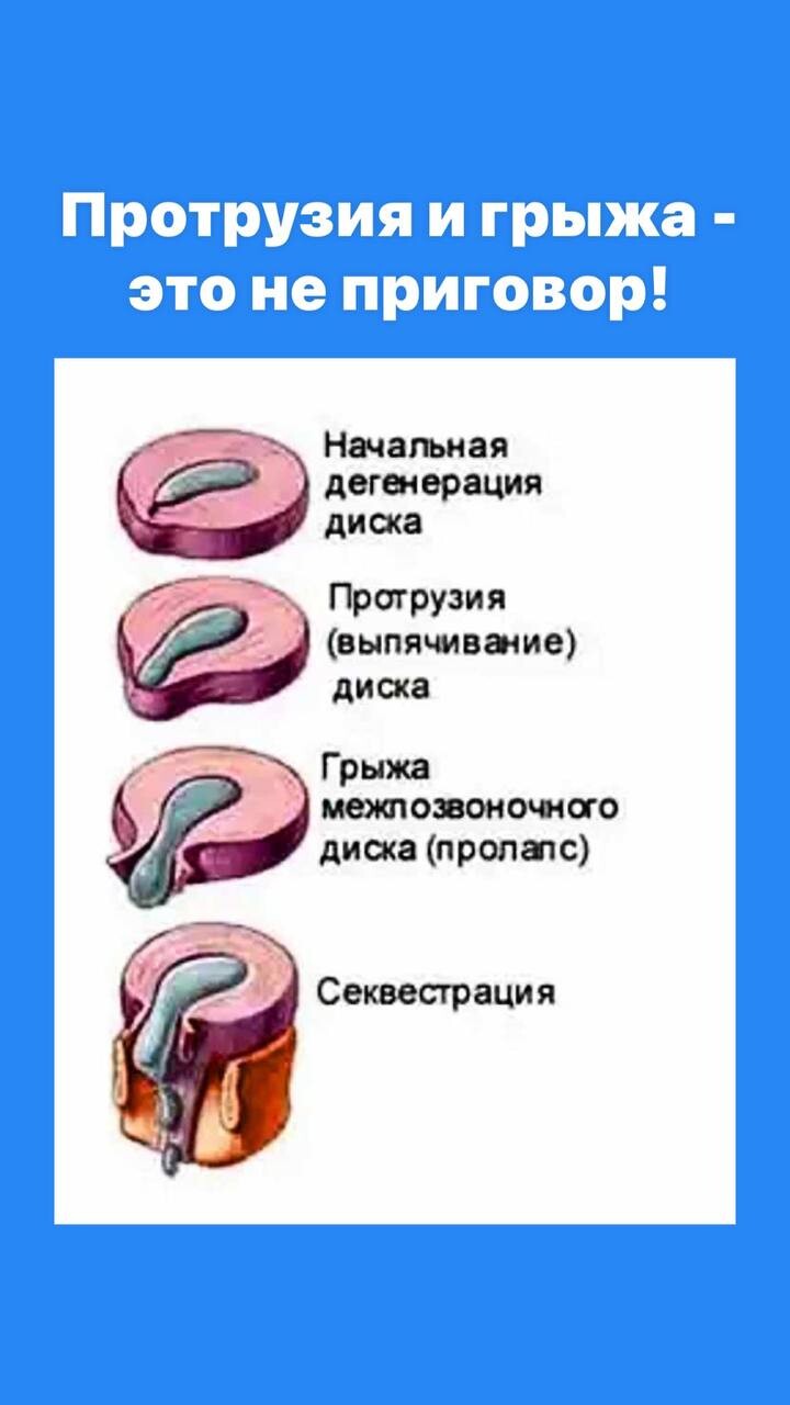 Пролабирование диска l3/l4. Препараты для регенерации позвоночных дисков. Пролабирование позвоночного диска. Воздух в дисках межпозвонковых. Фораминальная протрузия.