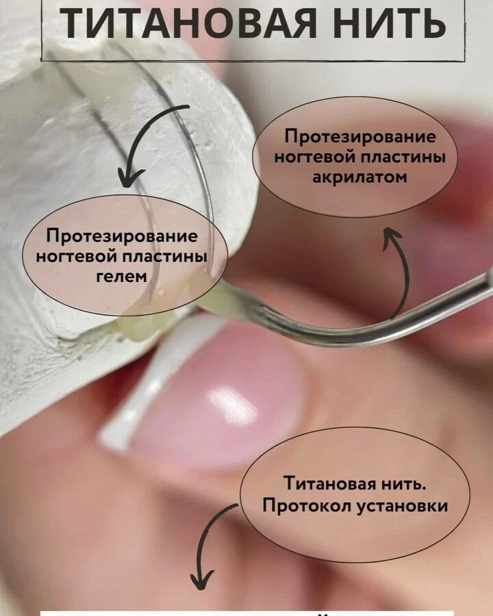 Титанов нить. Титановая нить для чего. Установка титановой нити.