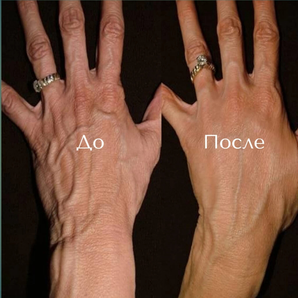 Сильное шелушение кожи. У меня нежная кожа. Восстановить кожу ладоней. Маски для кистей рук. Мазь для кожи.