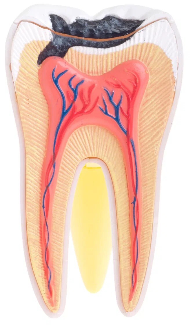 Пульпит зуба картинки