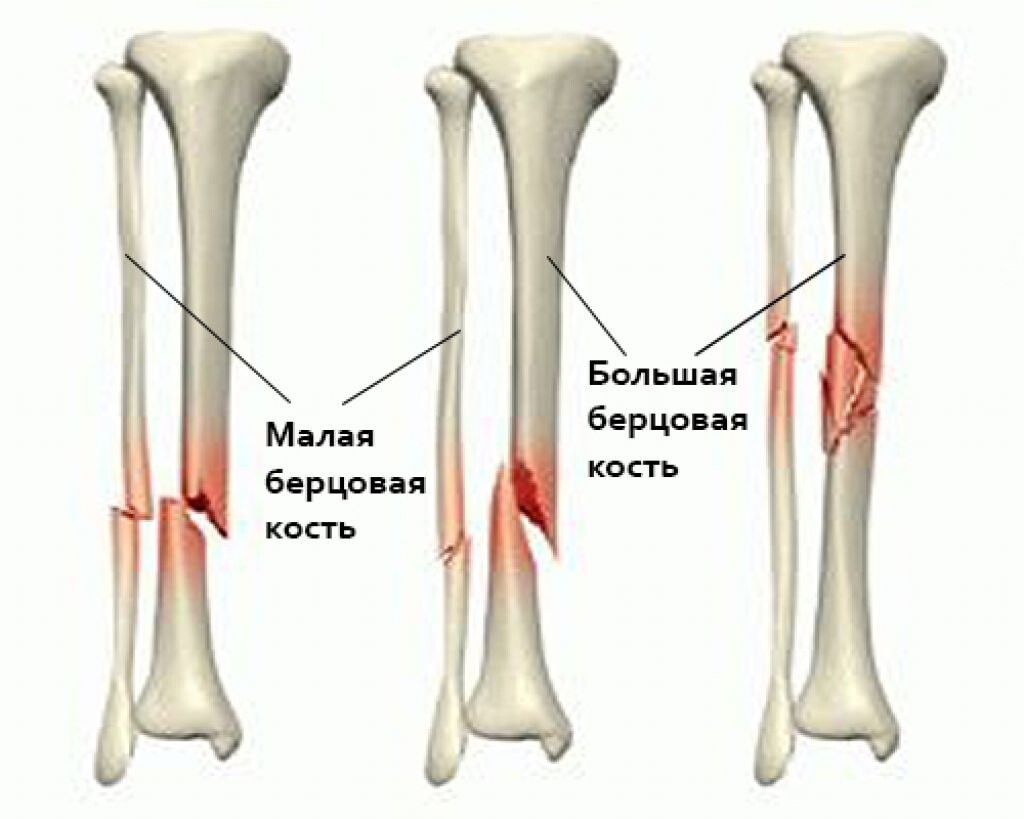 Отсутствия большой берцовой кости