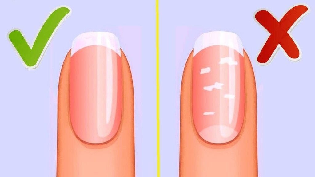 Чем лечить белые ногти. Белве пятна ЕС ногтях
