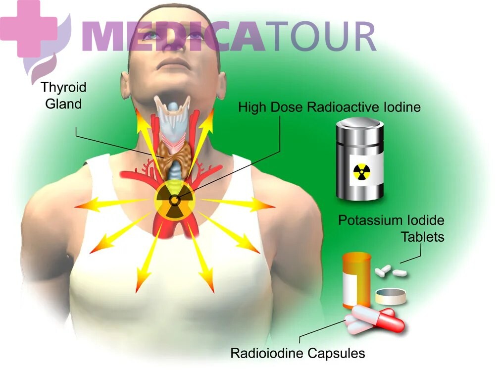 Радиойодтерапия щитовидной железы после операции. Радиойодтерапия щитовидной что это. Радиойодтерапия терапия щитовидной железы. Терапия радиоактивным йодом. Йодотерапия щитовидной железы.