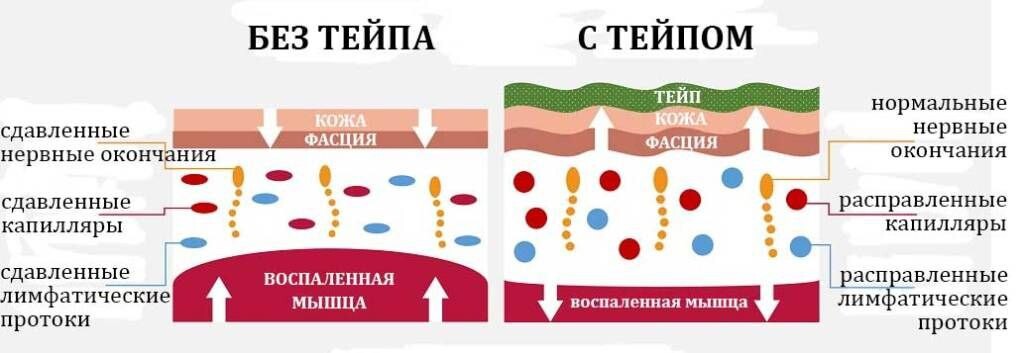 Тейпирование ног при отеках лимфодренажное схема