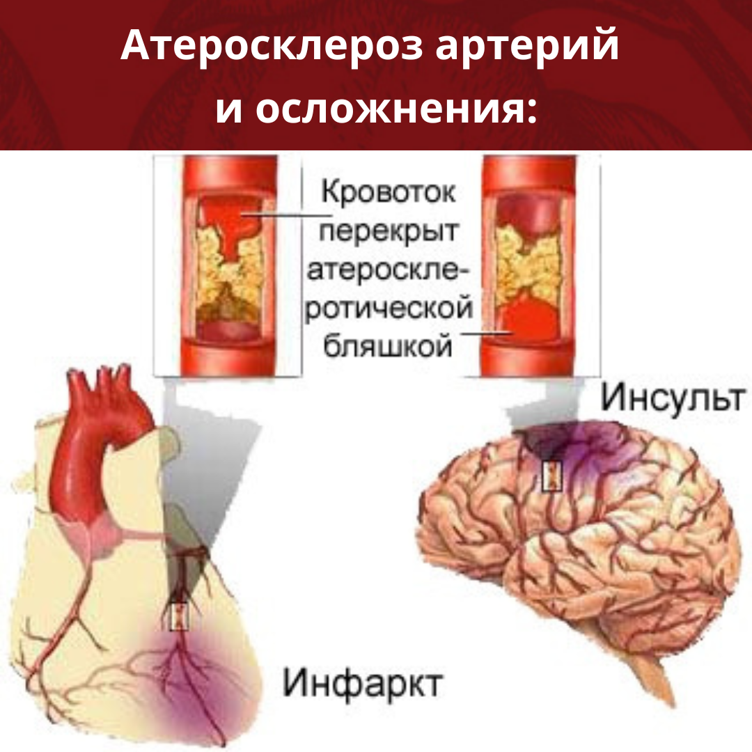 Инфаркт сердца тромб. Инсульт и инфаркт. Атеросклероз коронарных сосудов. Атеросклероз сосудов головного мозга.