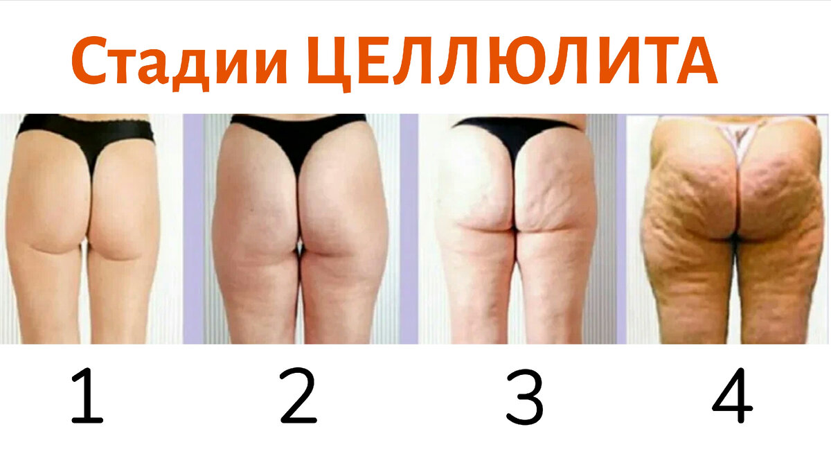 Как выглядит целлюлит на лице
