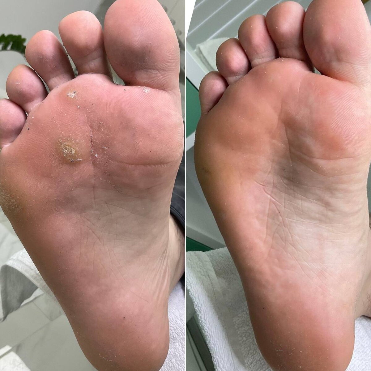 До и после лечения стопы у мальчика